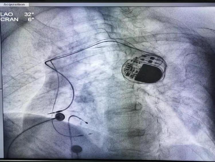 (术中起搏器及其导线x光片)