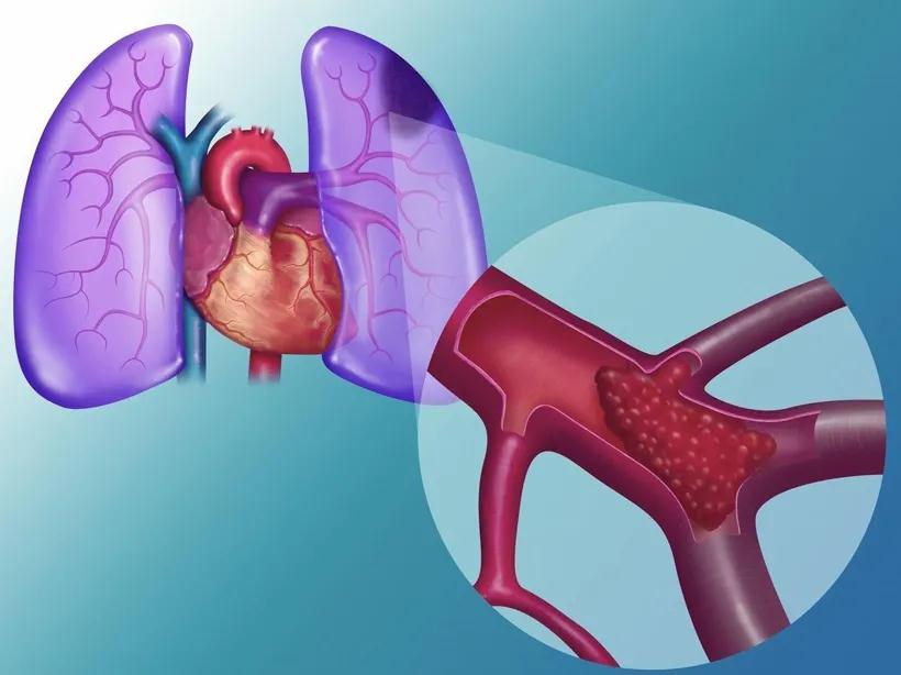 合川宏仁医院科普:肺栓塞——沉默的杀手
