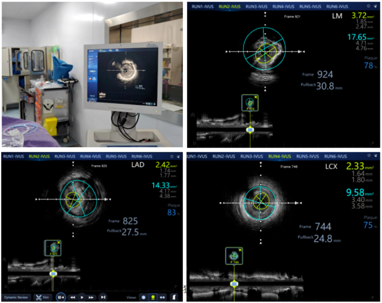 重庆市第七人民医院：血管内超声（IVUS）“导航”，精准治疗冠心病-第2张图片-中国中医健康网
