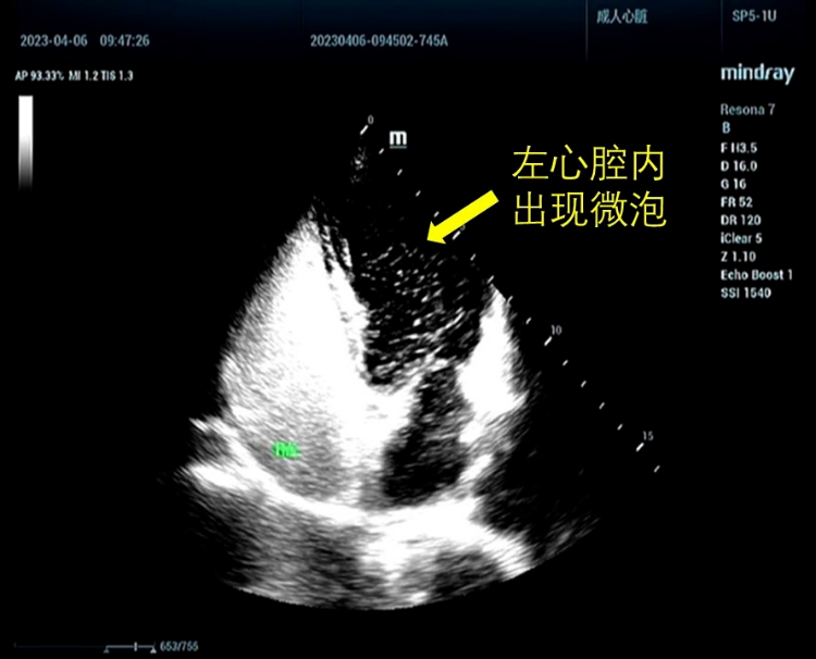 右心室调节束超声图像图片