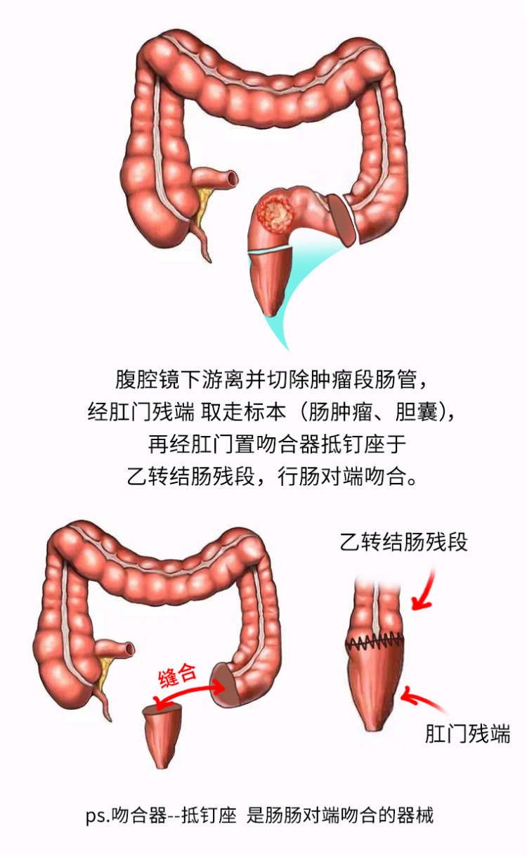 腹壁无切口切除直肠肿瘤重庆海吉亚医院胃肠外科成功开展noses手术