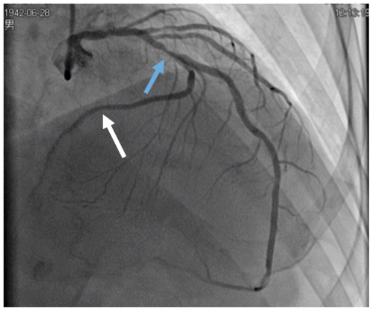 患者血管嚴重鈣化,左主幹病變(藍色箭頭),迴旋支閉塞(白色箭頭)/圖源