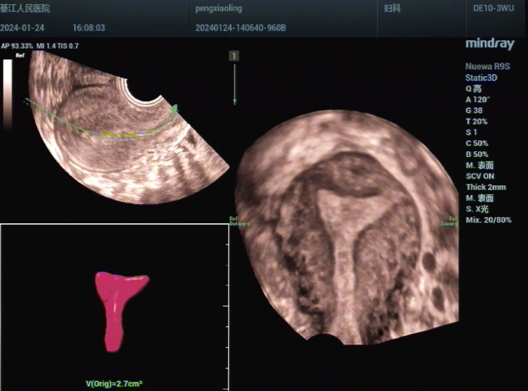 阴式彩超子宫图片