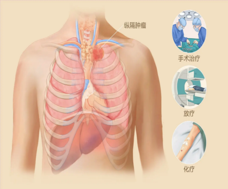 纵隔肿瘤位置图图片