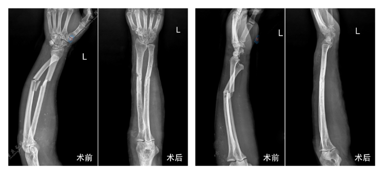 维修师傅重伤险截肢，重庆长城骨科医院实施精妙手术为患者重建肢体功能、重绘幸福蓝图