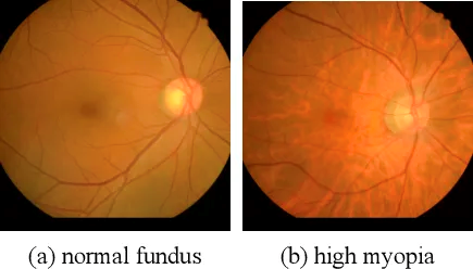 什么是青光眼白内障 bd26b5568b868ca4822bdd5ee2615eba.png
