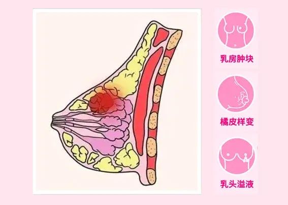 乳腺癌部分患者沒有明顯的臨床體徵或臨床體徵與其他良性病變類似,加