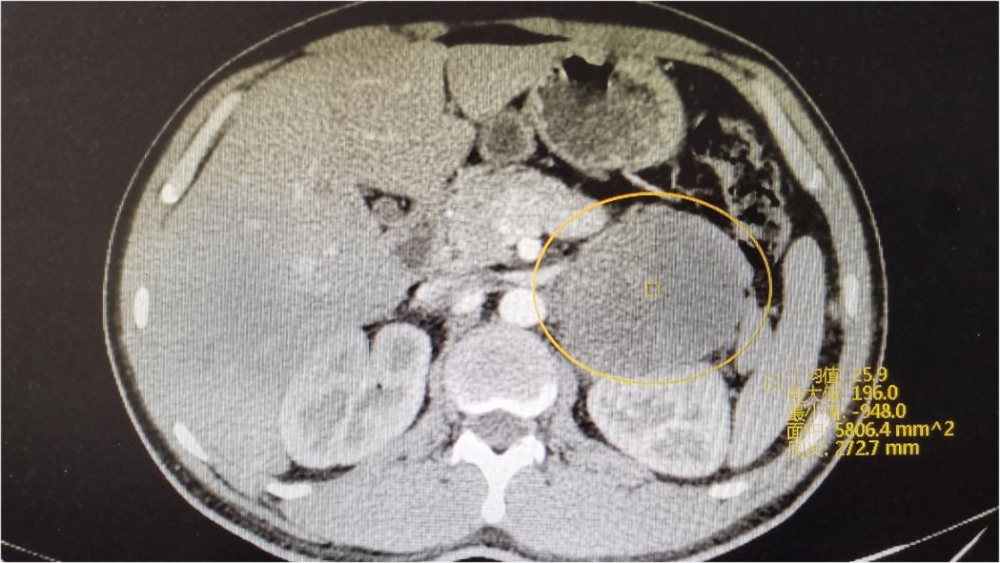 重庆市第五人民医院:巨大嗜铬细胞瘤作祟,30岁小哥腹部疼痛半月余
