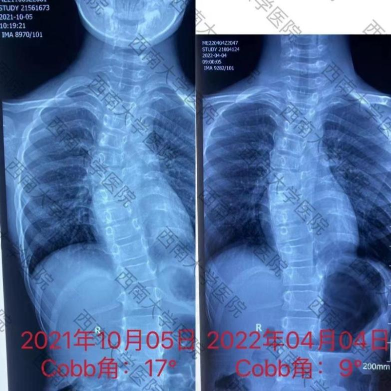 脊柱侧弯治疗前后对比9岁男童赵某,4岁时就被确诊脊柱侧弯,家长疡择