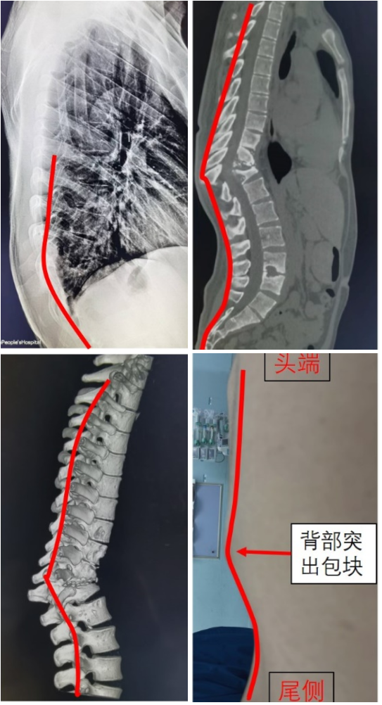 脊柱后凸畸形截骨矫形图片