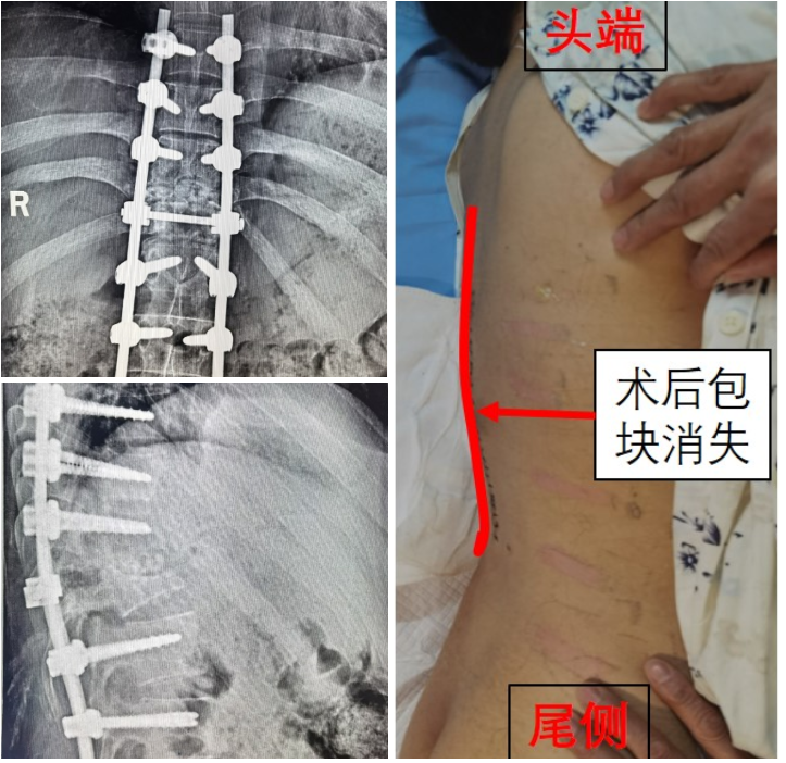 脊柱后凸畸形截骨矫形图片