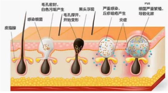 让你容颜焕发的美容神器，黑头仪有用吗？