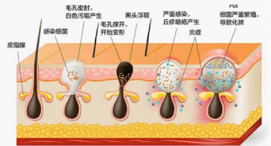 护肤保养很重要，黑头仪有用吗？