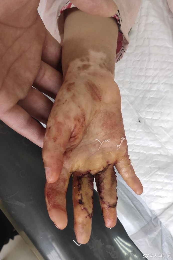 警方通报13岁男孩猥亵女童_继母涉嫌虐待继女致其残疾_十花汤警方立案