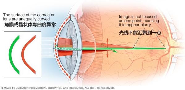 细数那些关于近视眼的谣言