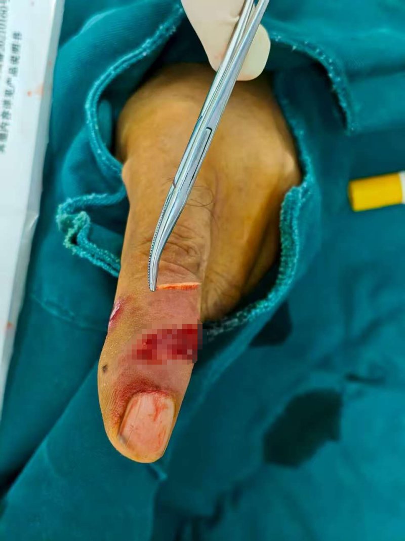 多大的伤口会导致破伤风 176240138932992525471360338600.jpg